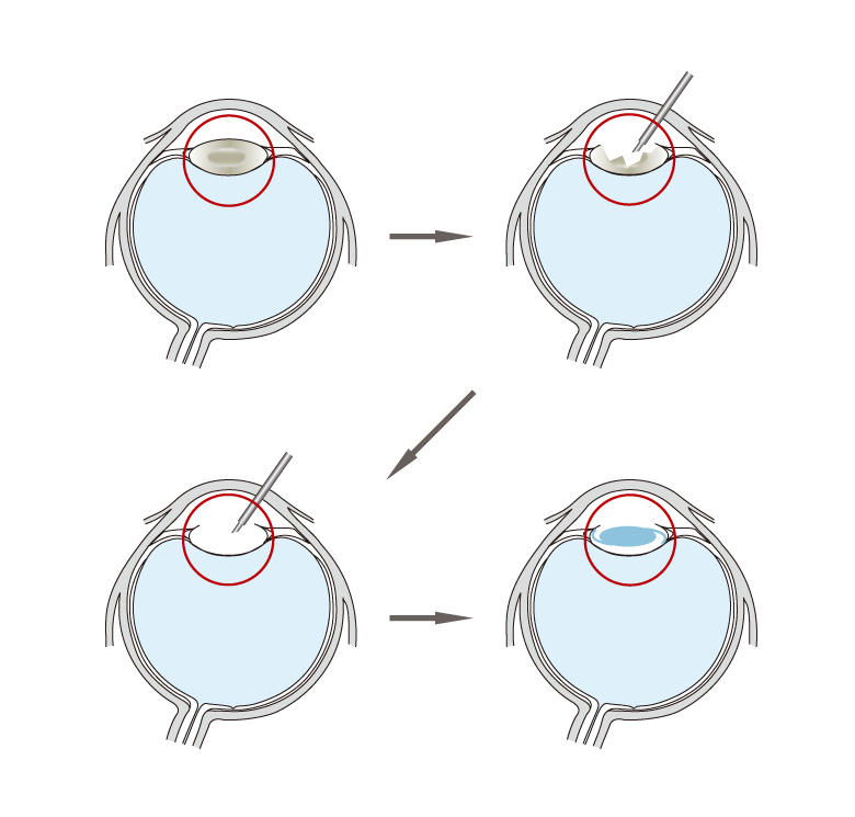 白内障手術の図