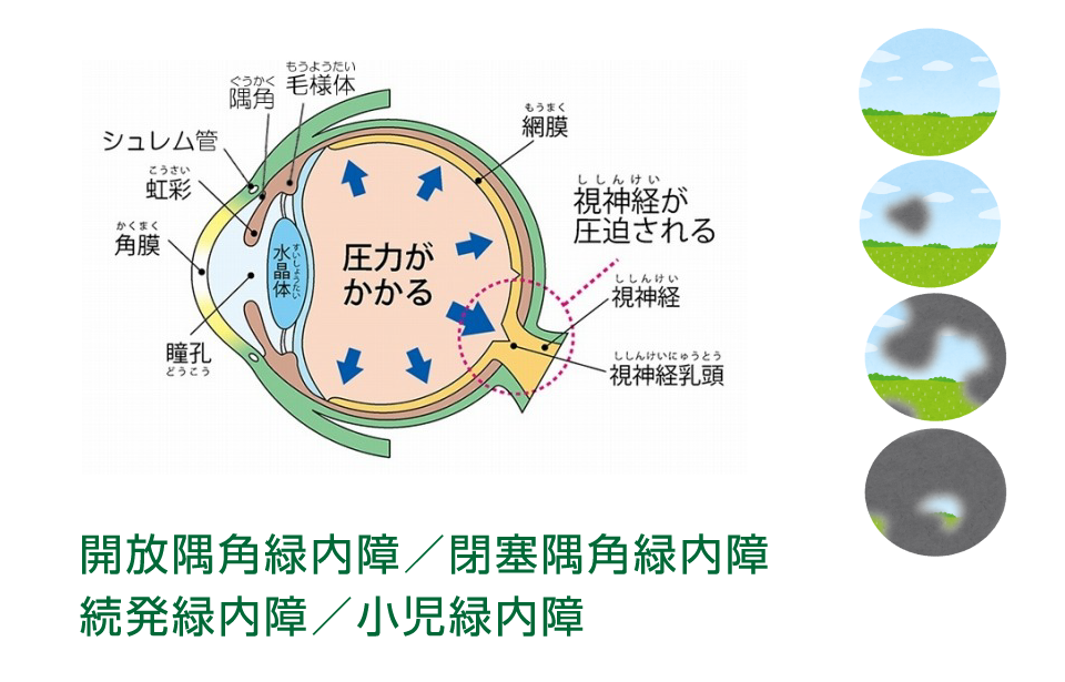 緑内障説明図 開放隅角緑内障・閉塞隅角緑内障・続発緑内障・小児緑内障